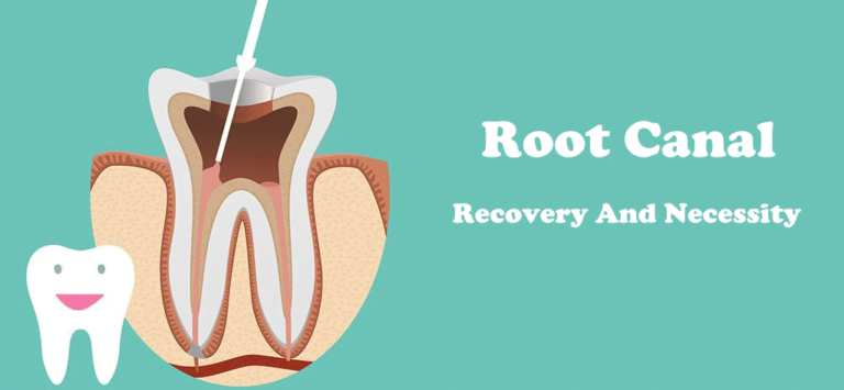 What Is Root Canal Recovery Time?