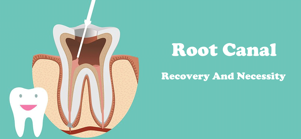 What Is Root Canal Recovery Time?