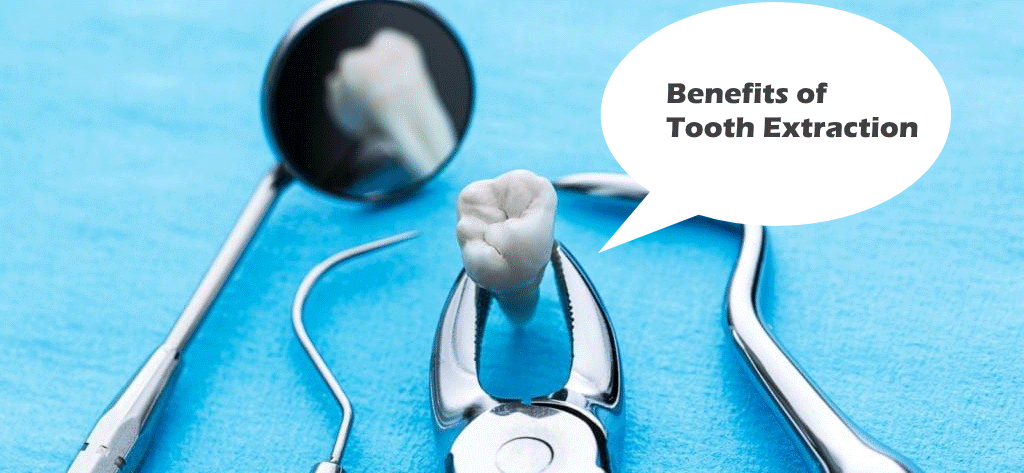What are the Benefits of Tooth Extraction