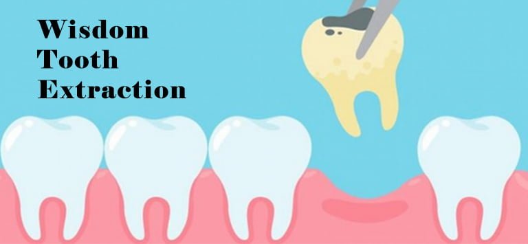 Soft Foods You Can Eat After Removal Of Your Wisdom Teeth