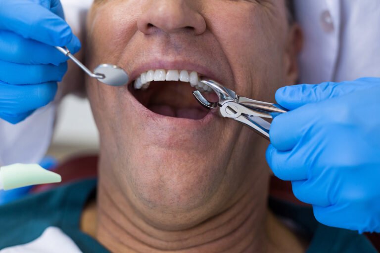What is The Tooth Extraction? Reasons, type, and details about tooth extraction
