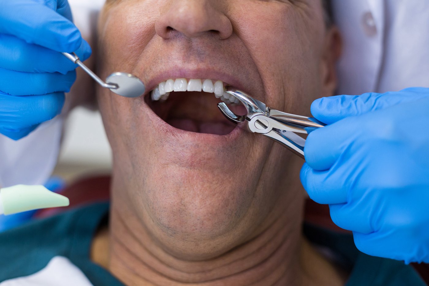 What is The Tooth Extraction? Reasons, type, and details about tooth extraction