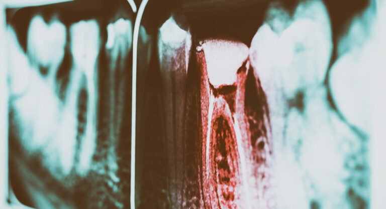 Tooth Decay: Symptoms and Treatment