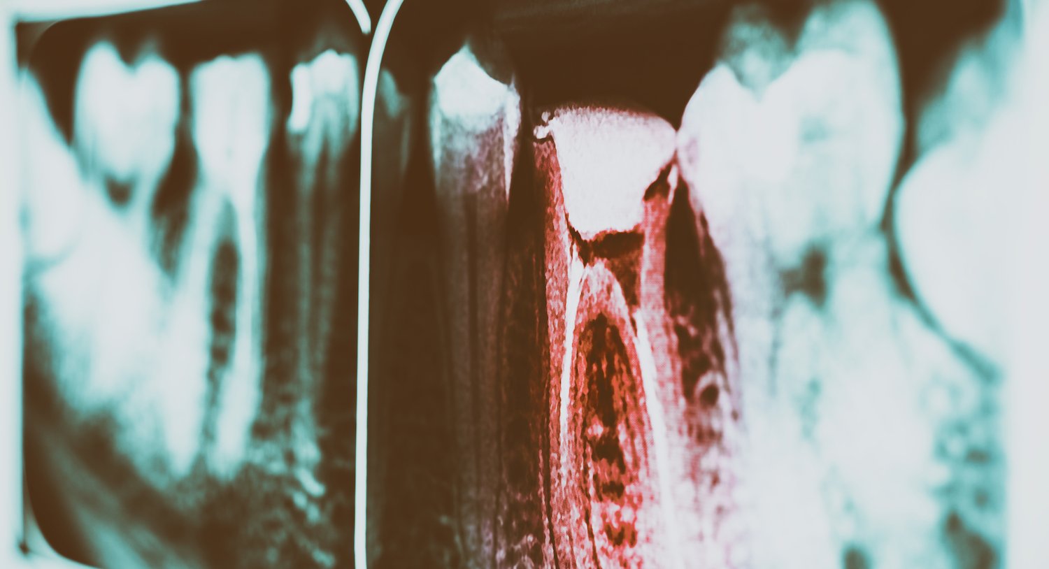 Tooth Decay: Symptoms and Treatment
