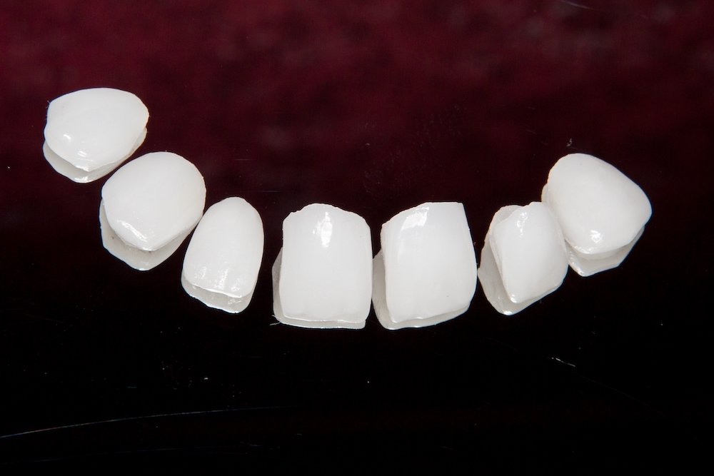 What are the key factors to consider when choosing dental crowns?