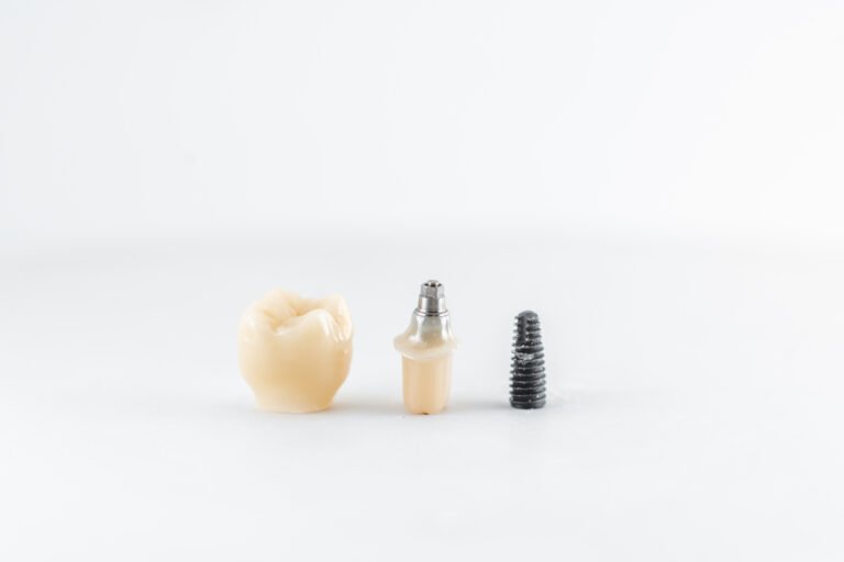 What are the things to consider before getting dental implants?