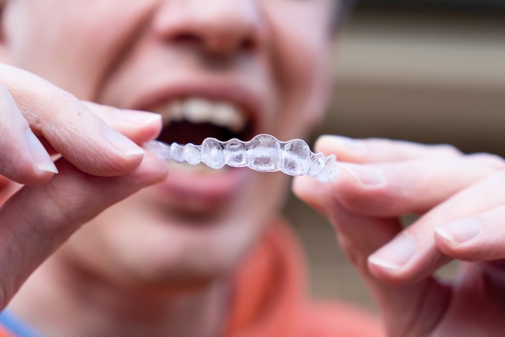 Types of Invisalign: Express, Lite, Moderate, Teen and First