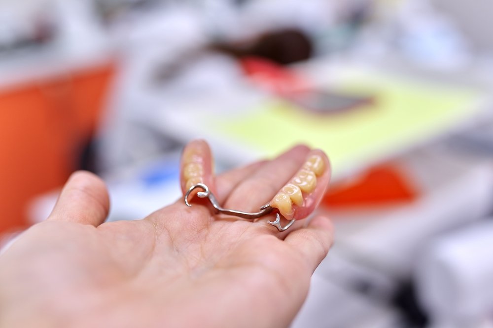 What Are the Common Types of Dental Bridges?