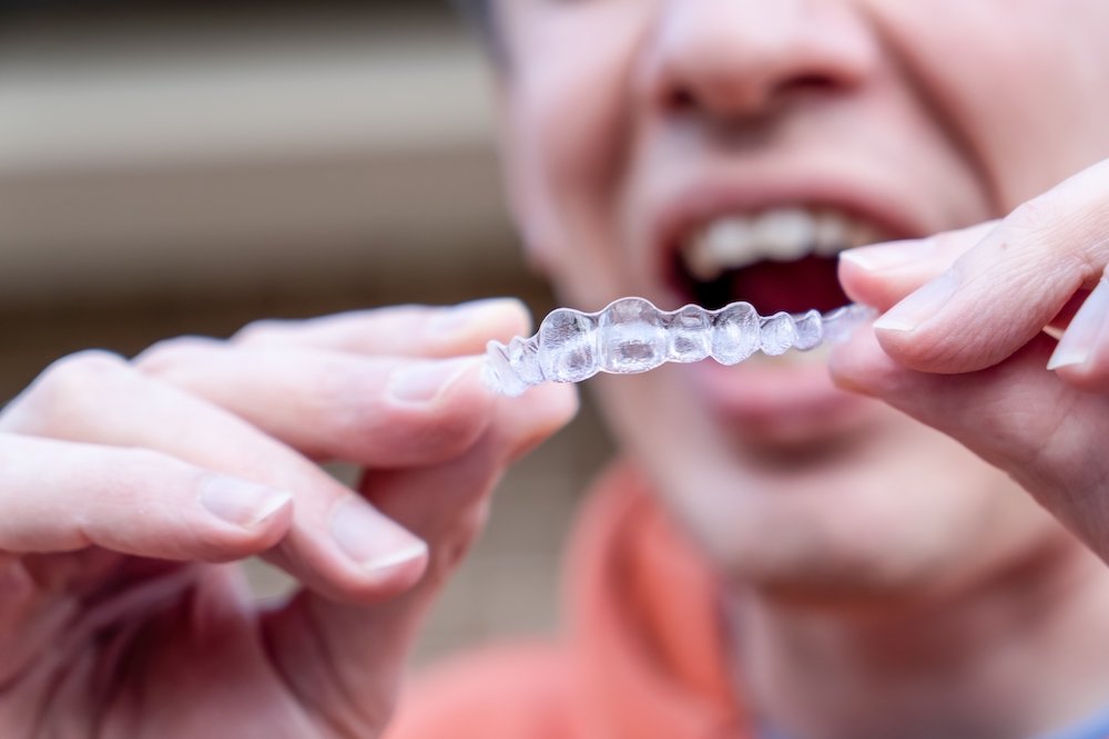 The Do’s and Don’Ts to Follow While Wearing Braces