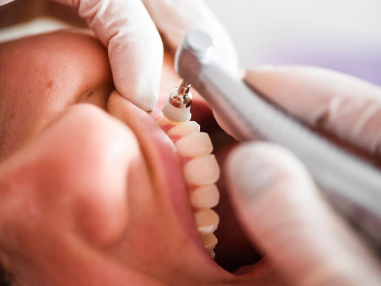 6 tips to follow after getting the dental cleaning treatment