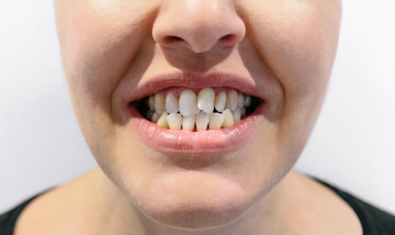 How to straighten crooked teeth?
