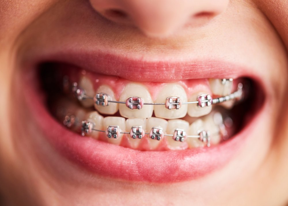 Top tips for dealing with painful braces