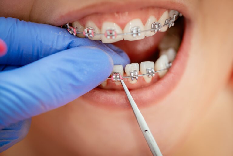 Permanent Retainers? Advantages and Its Disadvantages