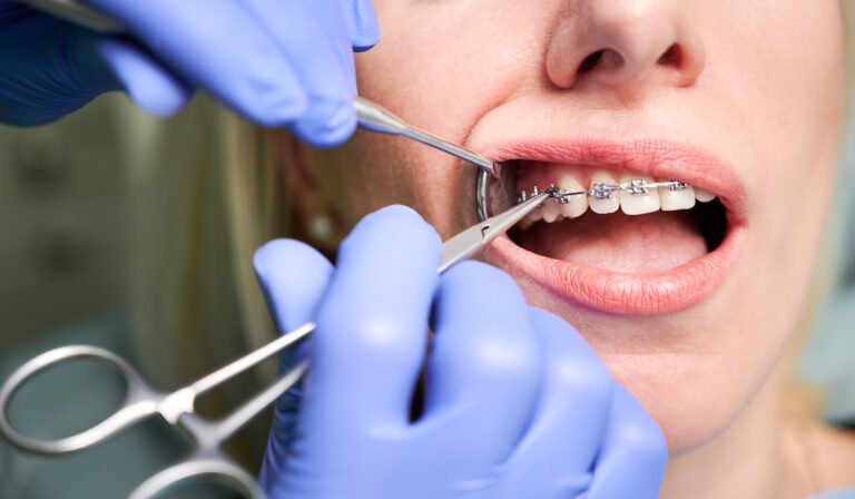 The Benefits of Orthodontic Treatment in Calgary: Beyond Straight Teeth