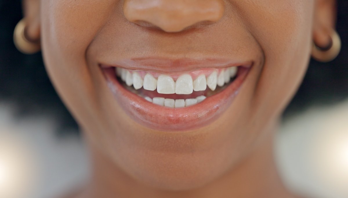 Invisible Alignment: The Invisalign Revolution in Teeth Straightening