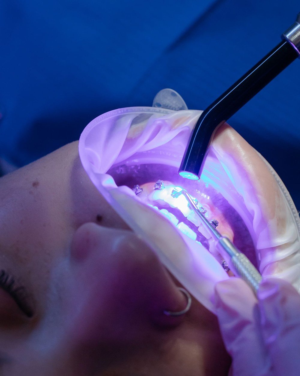 Orthodontic brackets being bonded to teeth with a curing light at The Port Dental Clinic Calgary NE