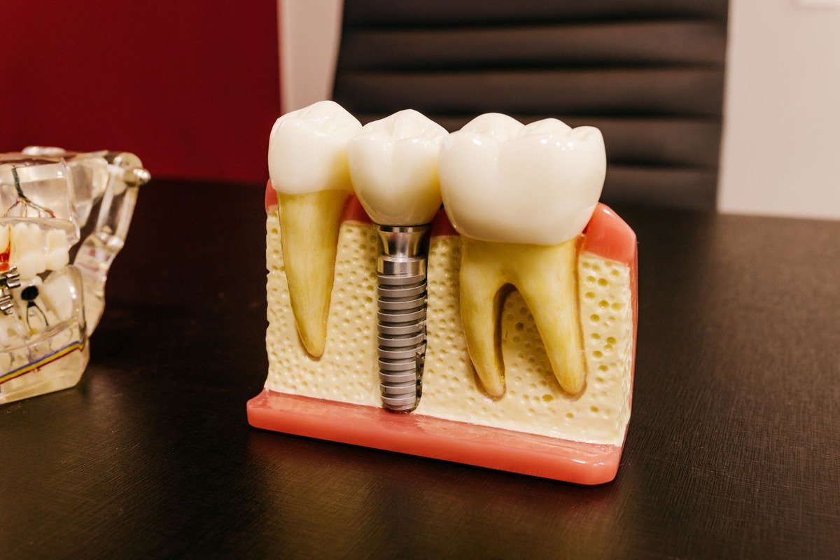 Dental implant model showing the titanium post, abutment and crown alongside natural teeth