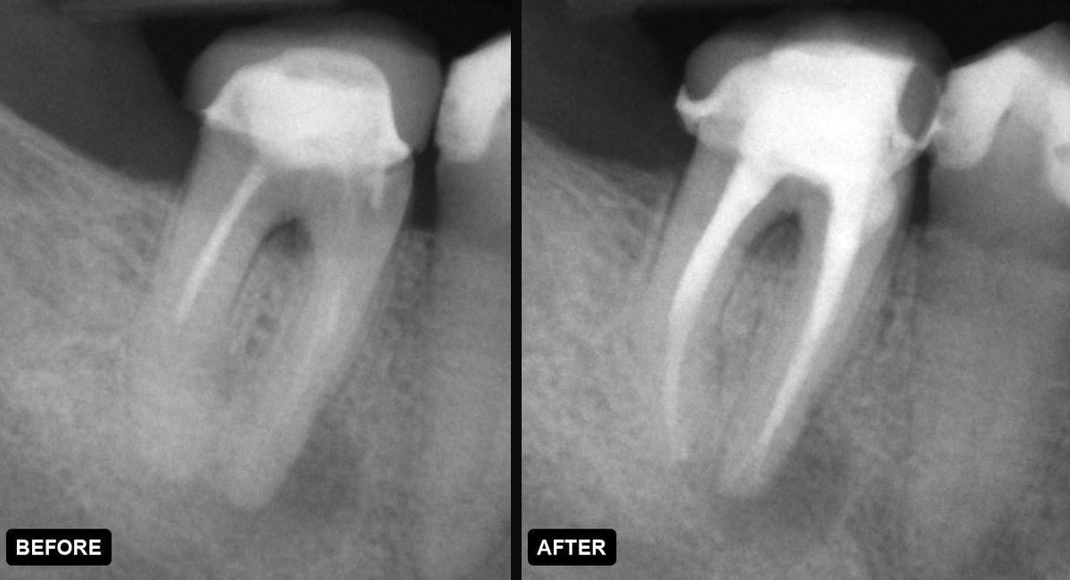 Dental X-rays of a lower molar before and after root canal treatment — the dark shadow at the root tip resolves once the canals are cleaned and sealed to the apex