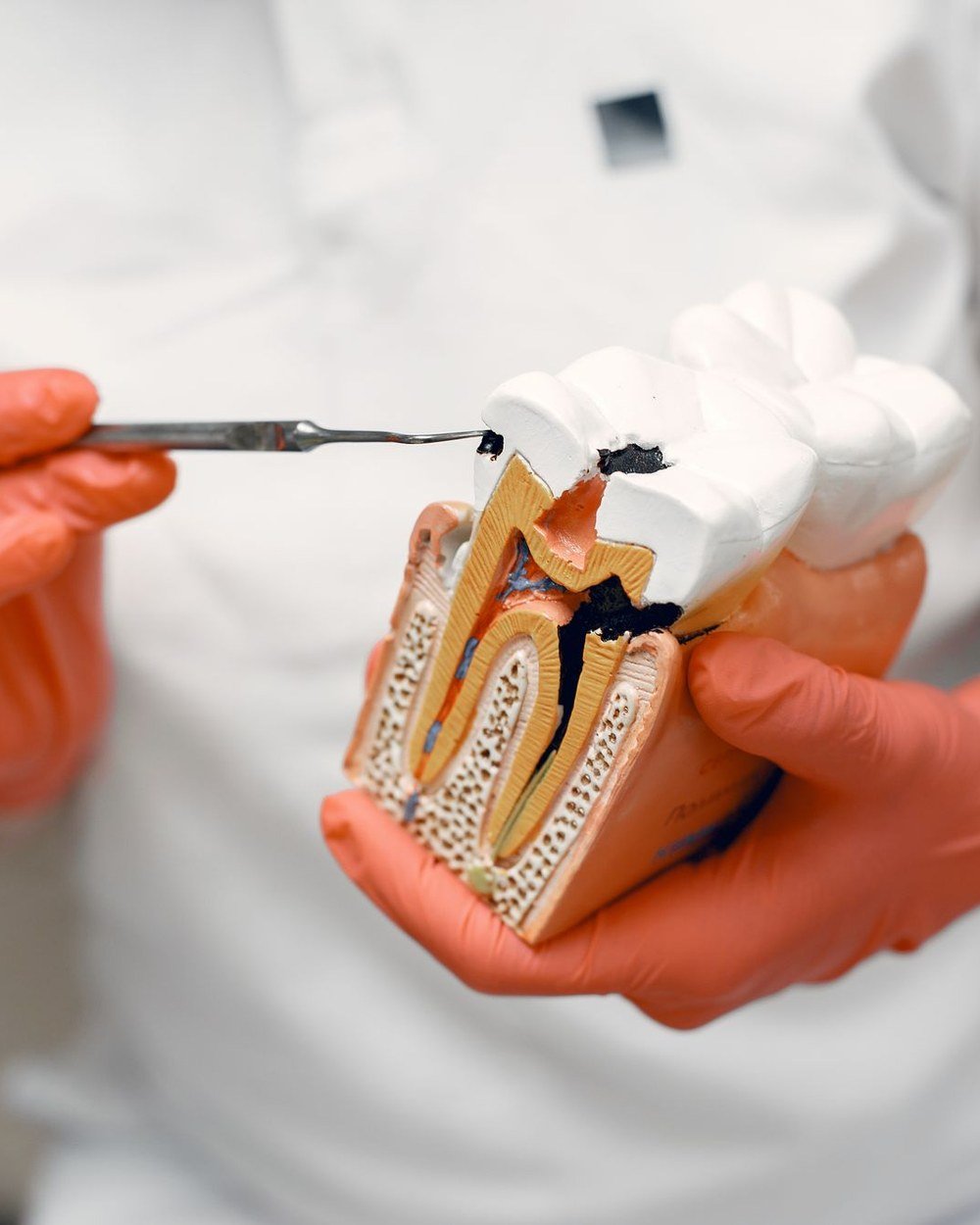 Dentist using a tooth cross-section model to show infected pulp inside the root canals at The Port Dental Clinic Calgary NE