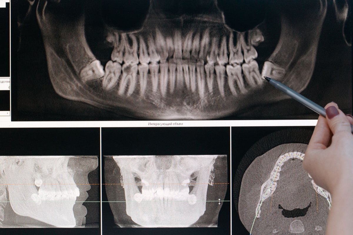Panoramic dental X-ray showing impacted wisdom teeth assessed at The Port Dental Clinic Calgary NE