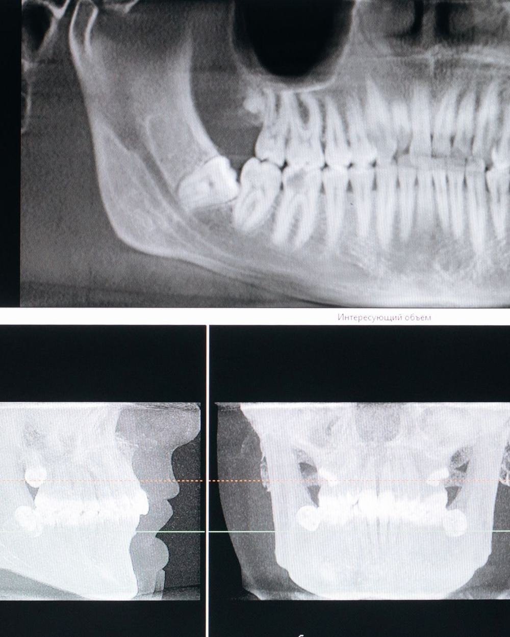 Dental imaging used to plan a wisdom tooth extraction at The Port Dental Clinic Calgary NE