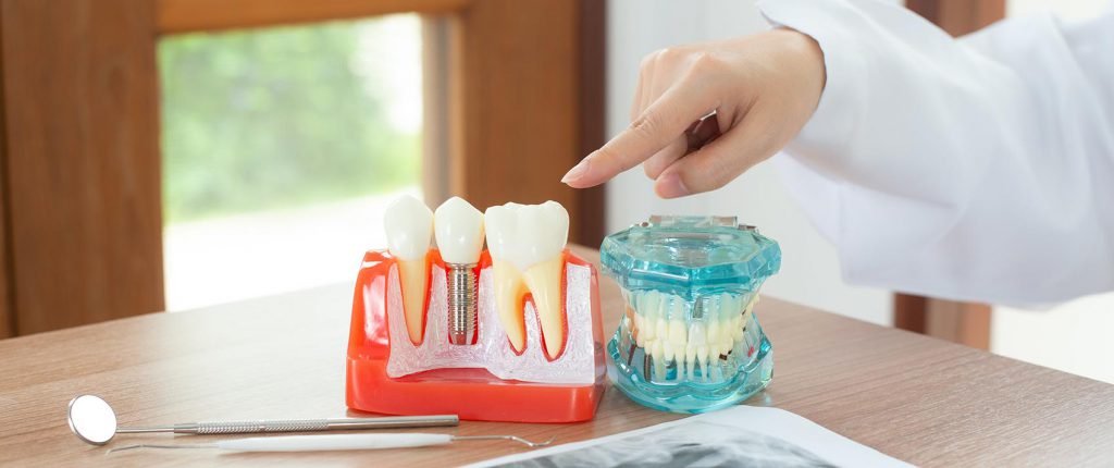 Dental implant model showing titanium post and crown at The Port Dental Clinic in Calgary