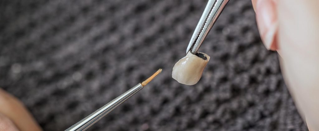 Dentist placing a custom dental crown on patient's tooth at The Port Dental Clinic Calgary NE