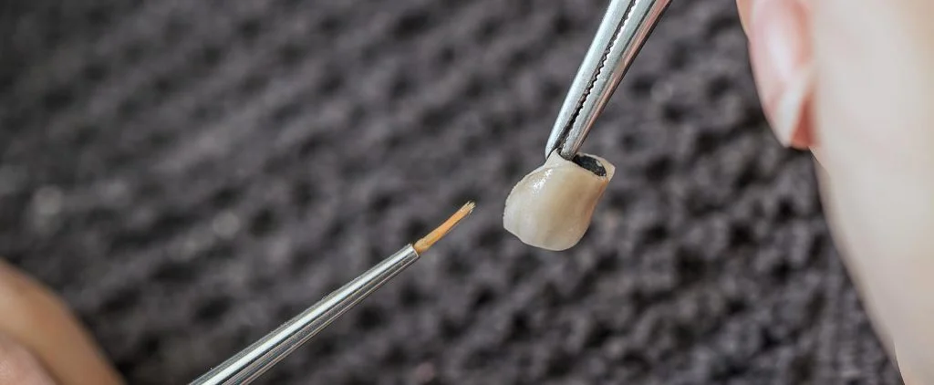 Dentist placing a custom dental crown on patient's tooth at The Port Dental Clinic Calgary NE