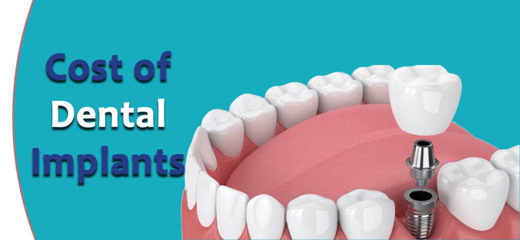 What Are The Factors Affecting The Cost Of Dental Implants?