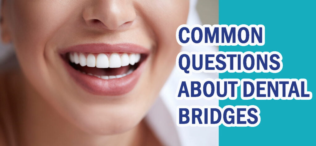 Common Questions About Dental Bridges