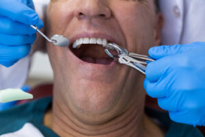 Dentist using surgical pliers to remove a decaying tooth