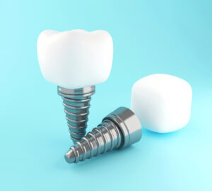 What are the advantages of getting dental implants?