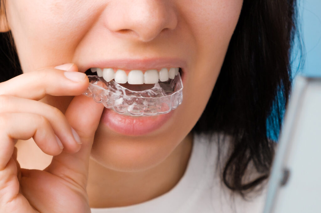 Take care of your oral hygiene while wearing braces