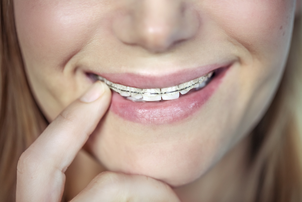 Understanding the components and working mechanism of braces