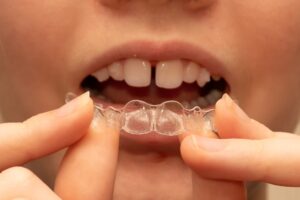 11 Ways to Take Care of Your Invisalign