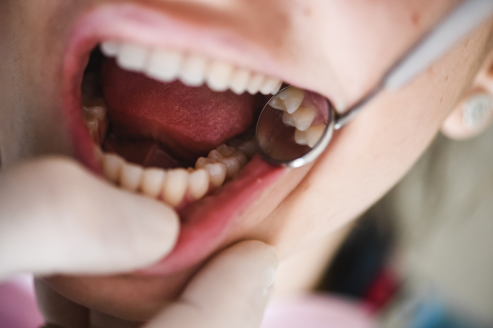 What are the common dental issues during Christmas, and how to avoid those?
