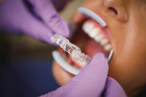 Invisalign vs Traditional Braces : Differences between them