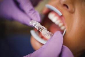 How Dentists Help Achieve Perfect Smile Through Invisalign Treatment and Dental Aesthetics