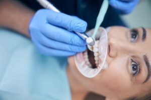 Get Teeth cleaning in Calgary today. A close-up of teeth being cleaned by a dentist, highlighting the removal of plaque and tartar.
