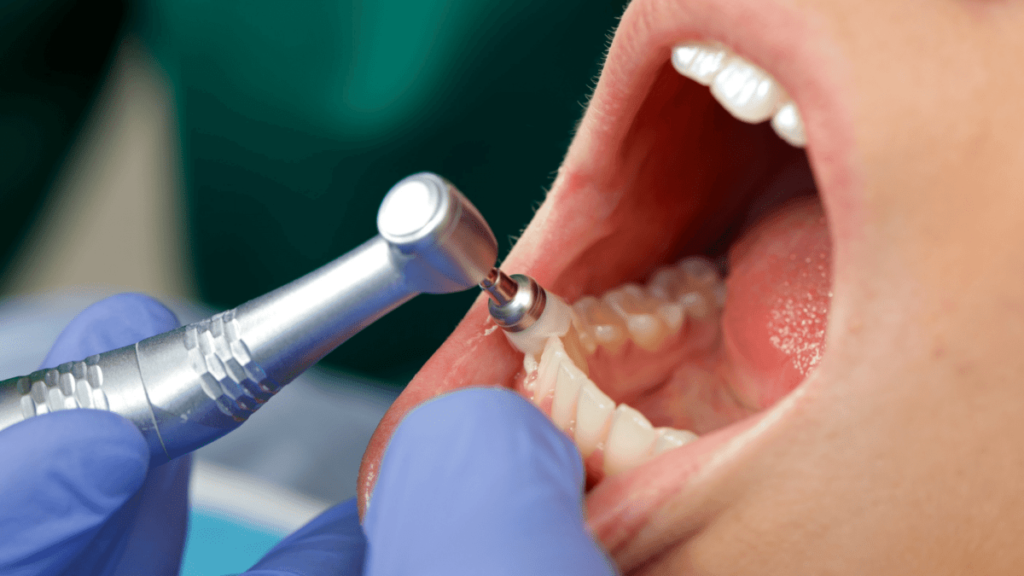 Importance of regular teeth cleaning